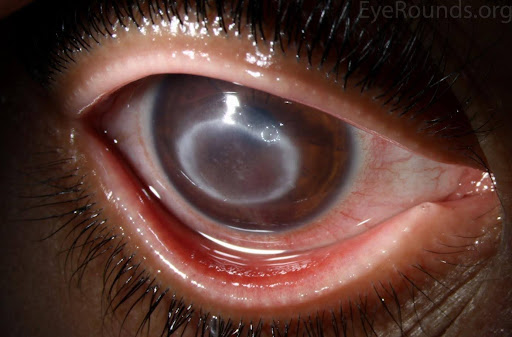 Abbildung 2: In der Abbildung ist ein ausgeprägtes Ringinfiltrat der Hornhaut erkennbar, welches durch Acanthamoeba verursacht wurde. Das Foto wurde von Jesse Vislisel, MD und Brice Critser, CRA aufgenommen und zur Verfügung gestellt.5